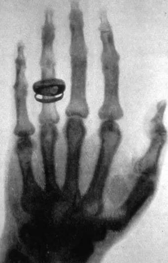 威廉·康拉德·伦琴和X光照片
